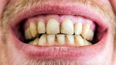 What happens if you do not remove tartar from your teeth